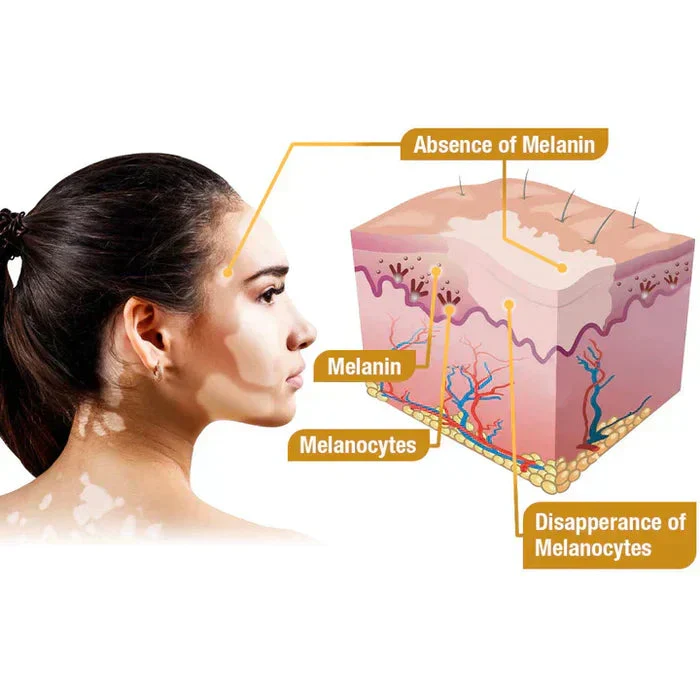VitiGO™ Bee Venom Corrector Cream