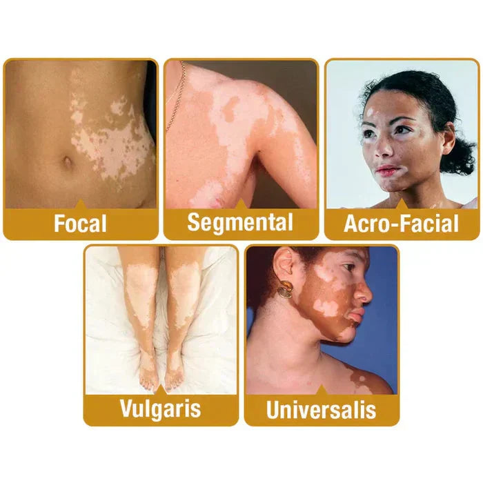 VitiGO™ Bee Venom Corrector Cream